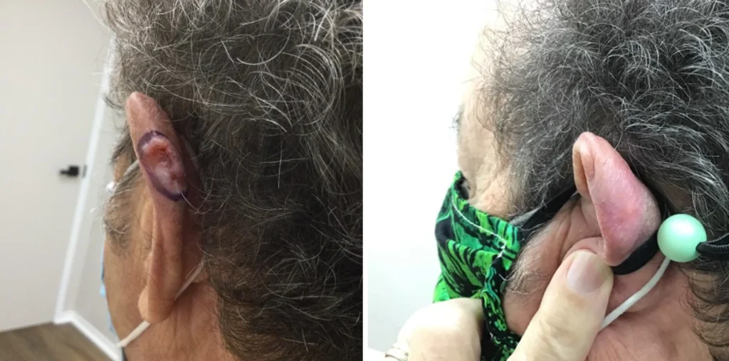 Side-by-side comparison of a patient's ear before and after GentleCure image-guided SRT treatment. The left image shows a visible lesion, while the right image shows healed skin with minimal discoloration.