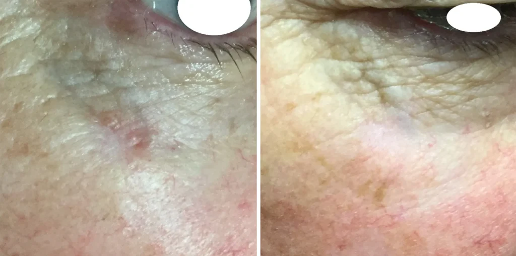 Close-up view of the area near the eye, showing before and after GentleCure treatment. The left image displays a small lesion, while the right image reveals smoother skin with reduced redness.