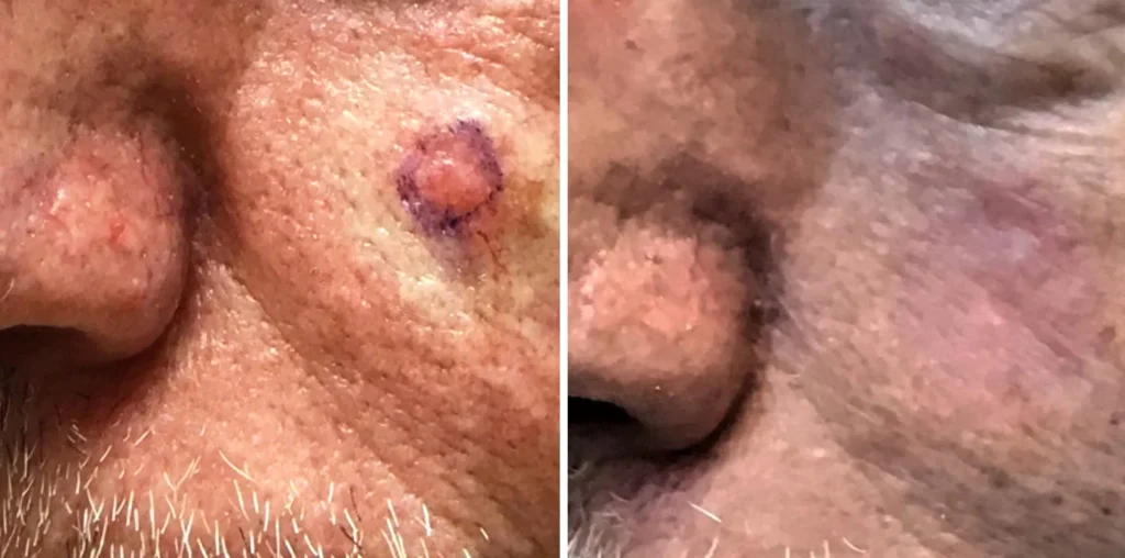 Before-and-after images of a patient’s cheek following GentleCure treatment. The left side shows a noticeable lesion, and the right side shows healed skin with improved texture and tone.