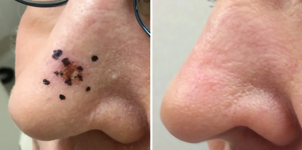 Comparison of a patient’s nose before and after GentleCure image-guided SRT treatment. The left image shows dark spots and scabbing; the right image displays smooth, clear skin.