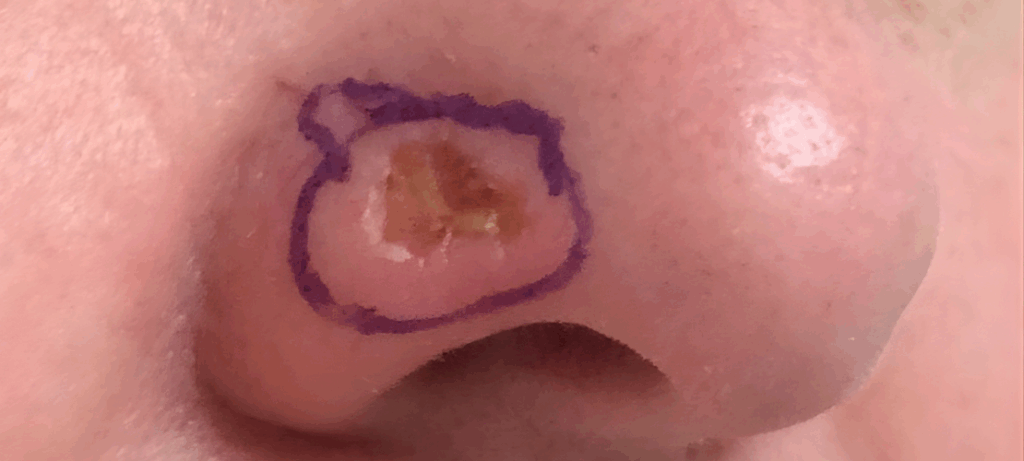 Basal cell skin cancer on a person's nose