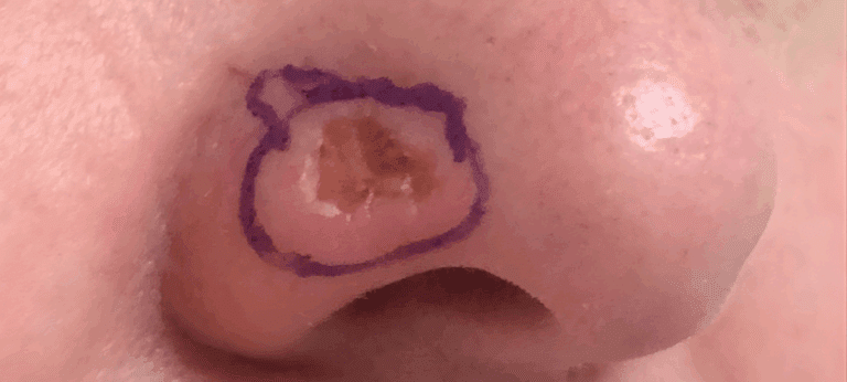 Basal cell skin cancer on a person's nose