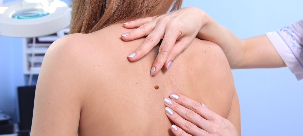 Doctor inspecting woman patient skin on her for melanoma