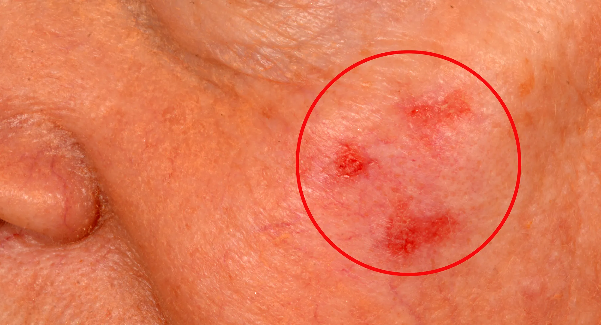 Red patches example on the cheek, an area that is frequently sun-exposed