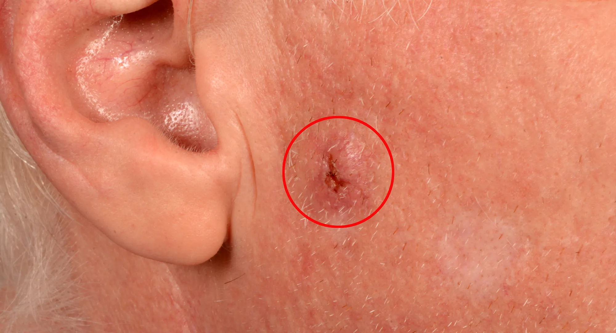 Crusted lesion example on the outer ear that has not healed