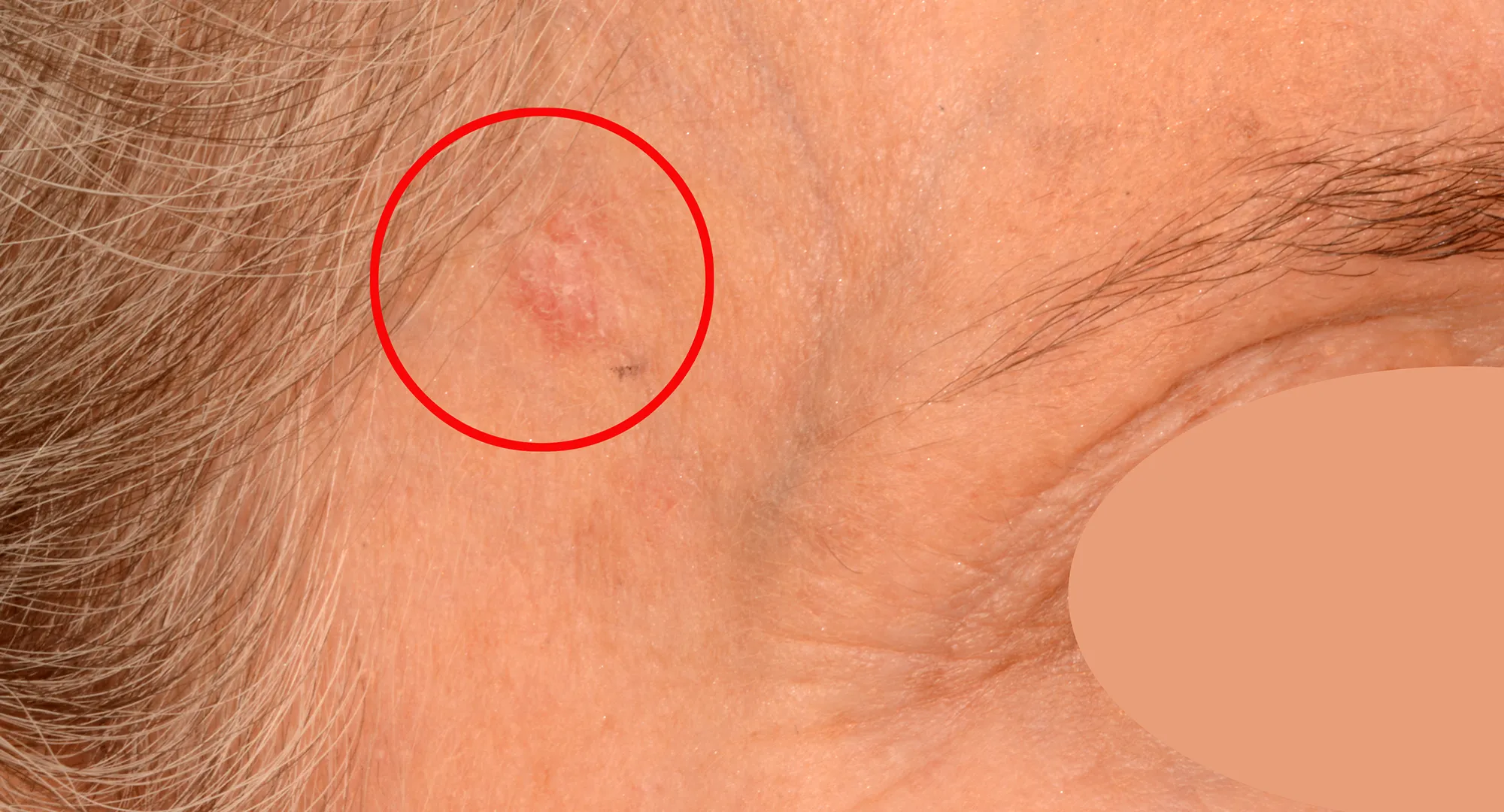 Scaly patch example along the hairline, one of several ways skin cancer can appear on the face