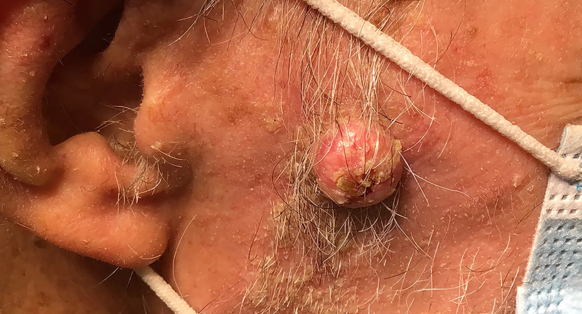 Pink nodule example near the sideburn area of the face