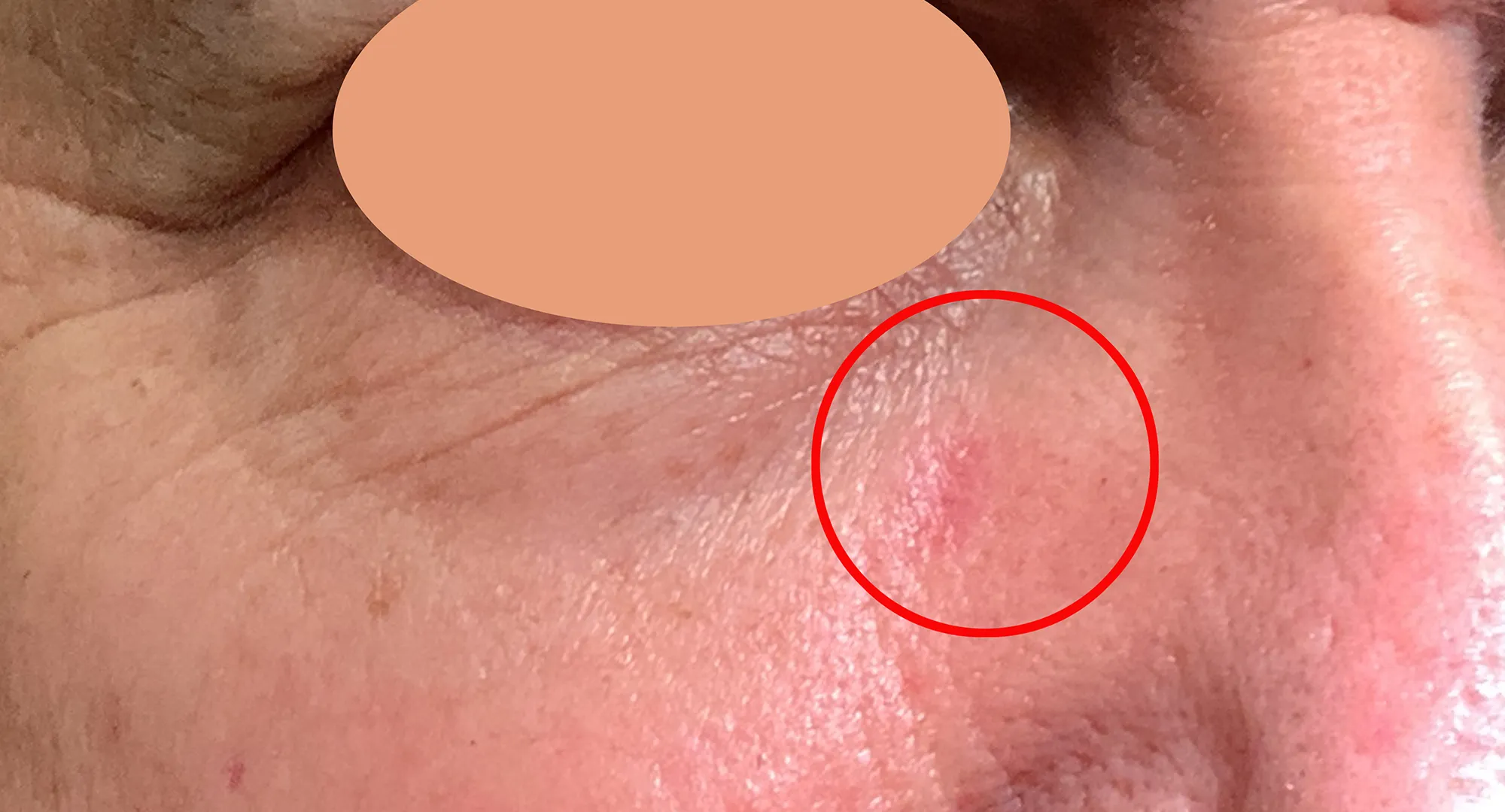 Pink patch example on the temple, an area often missed during sunscreen application