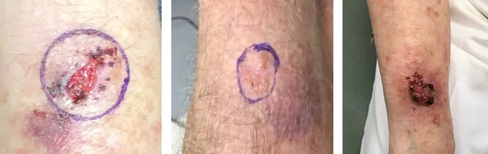 Forearm biopsy site shown across different healing stages