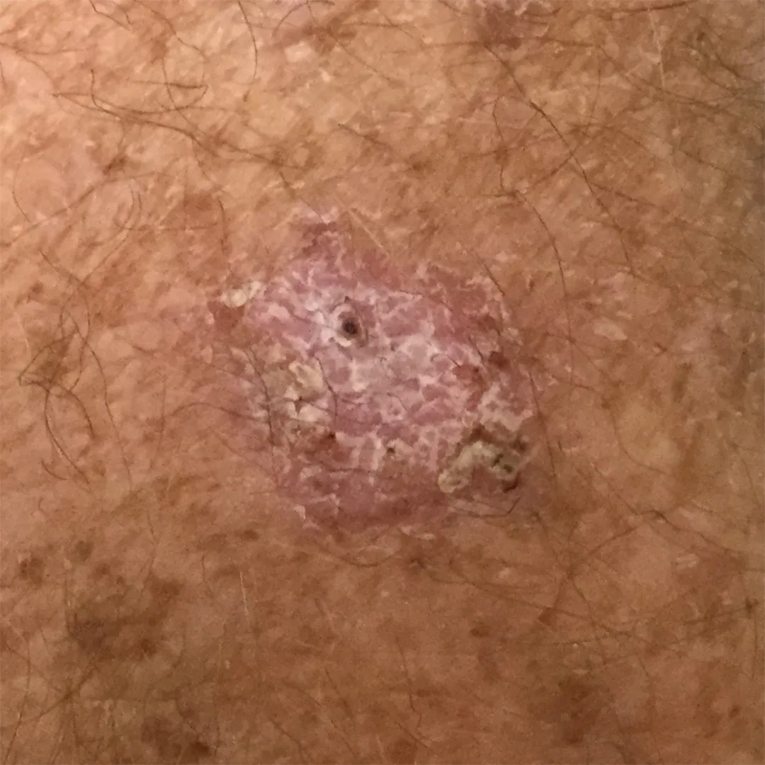 Close-up example of a skin cancer lesion on the forearm