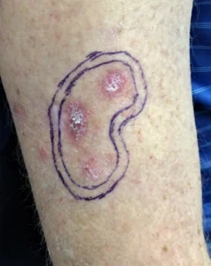 Forearm lesion outlined in marker ahead of treatment or biopsy