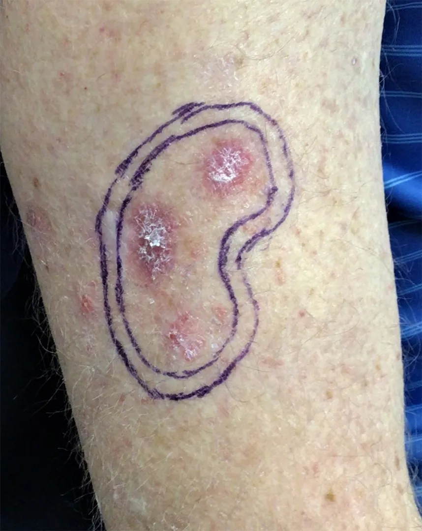 Marked forearm lesion example outlined for closer examination