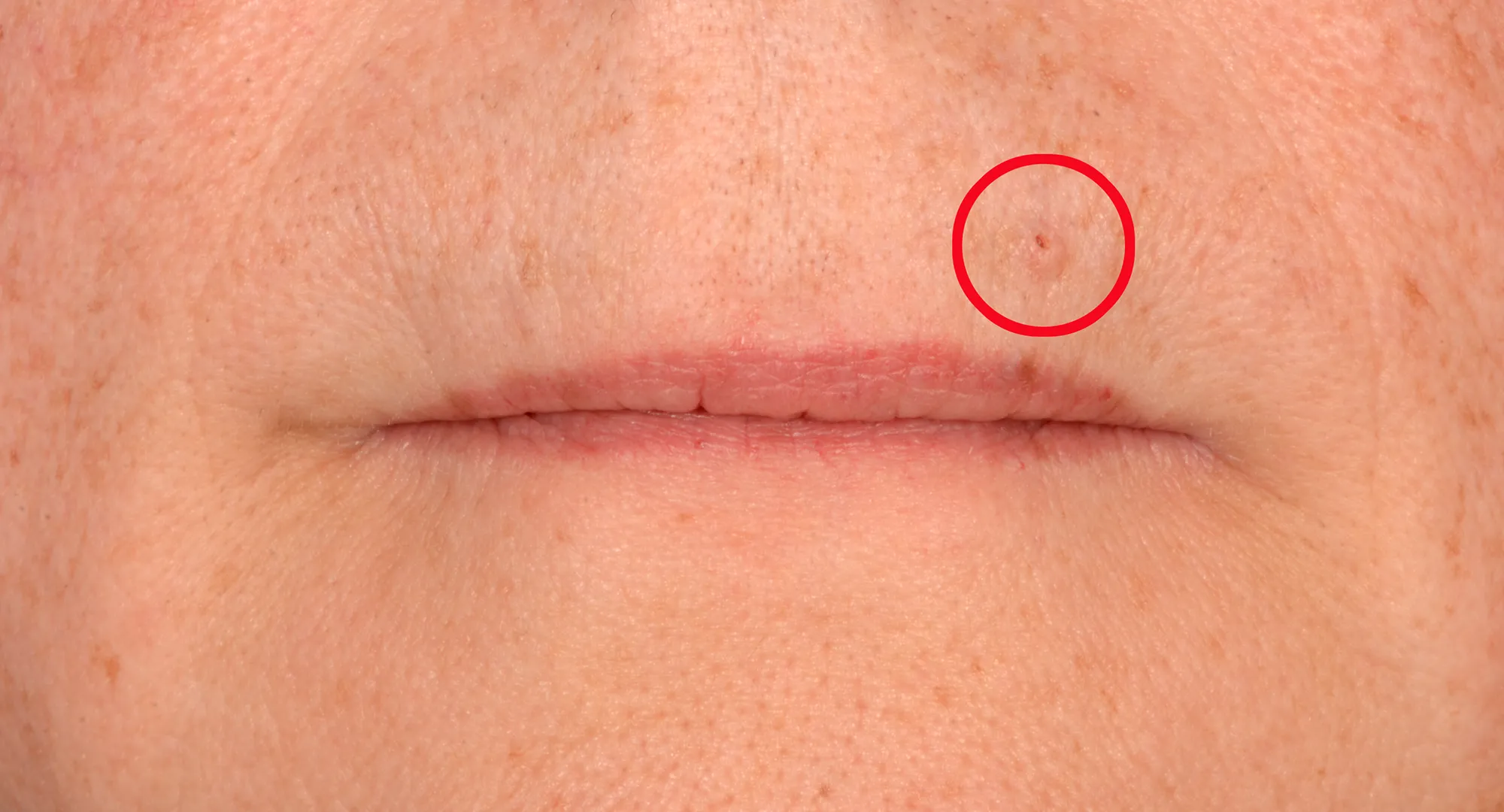 Faint red bump example on the lower lip