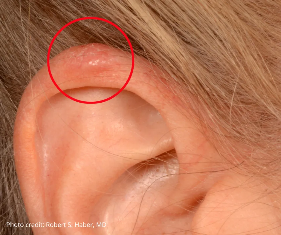 Close-up of an ear with a red circle highlighting a small skin cancer lesion on the upper ear. The affected area appears slightly raised and discolored. Photo credit: Robert S. Haber, MD.