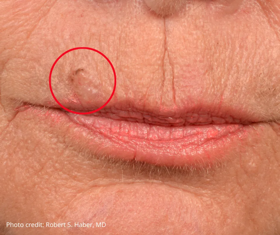 Close-up of lips with a red circle highlighting a raised, discolored lesion on the upper lip, indicating a potential case of skin cancer. Photo credit: Robert S. Haber, MD.