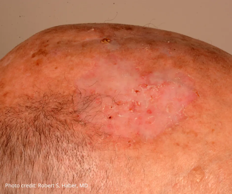 Close-up of a scalp with a visible skin cancer lesion, showing a large, red, scaly patch with irritation and flaking skin. Photo credit: Robert S. Haber, MD.