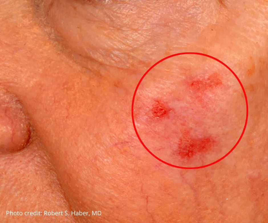 Close-up of a facial skin cancer lesion highlighted with a red circle, showing red, scaly patches on the cheek. Photo credit: Robert S. Haber, MD.