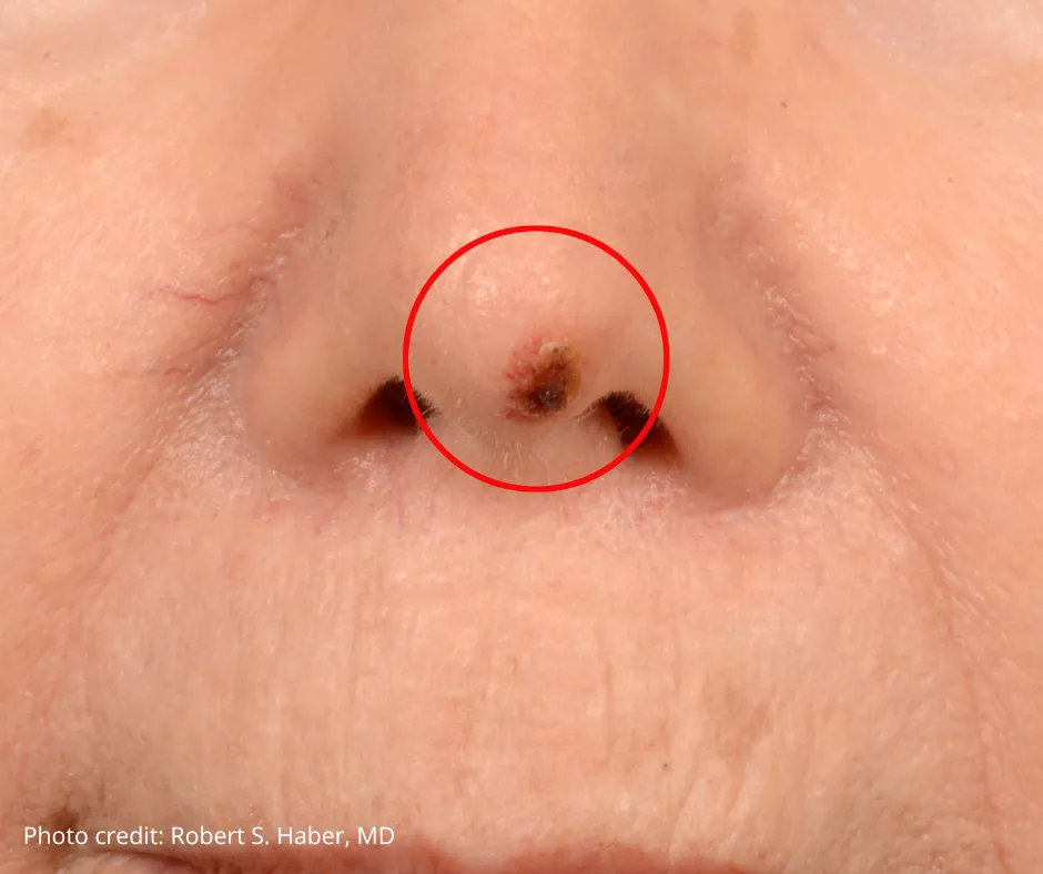 Close-up of the nose with a red circle highlighting a small, raised skin cancer lesion near the nostril, featuring a crusted and discolored surface. Photo credit: Robert S. Haber, MD.