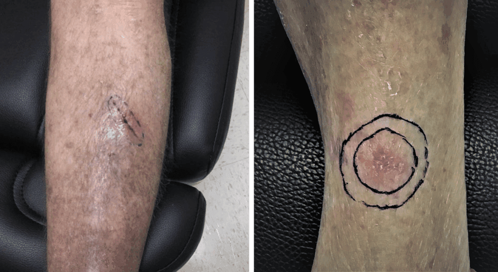 Two photos of skin cancer on the lower leg, showing lesions with medical markings around them to illustrate how skin cancer can appear on legs.