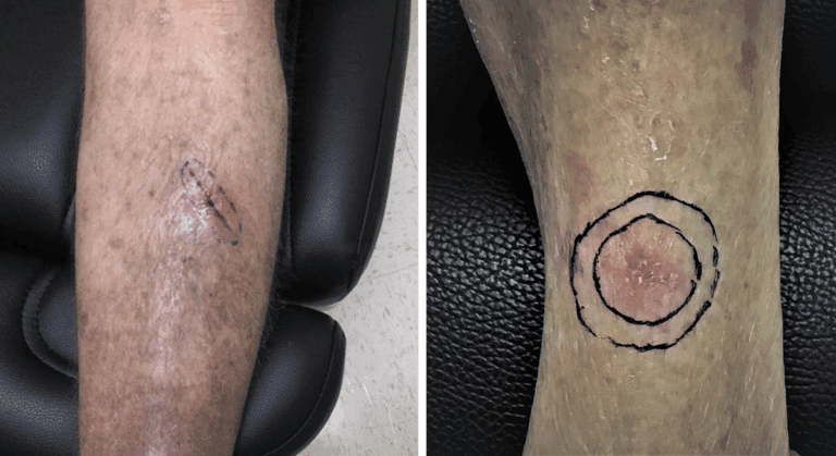 Two photos of skin cancer on the lower leg, showing lesions with medical markings around them to illustrate how skin cancer can appear on legs.
