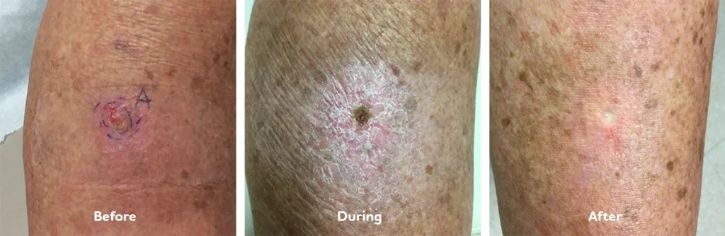 Collage showing a skin cancer lesion on the leg before IGSRT treatment (raised lesion), during treatment (healing with scab), and after treatment (skin healed).