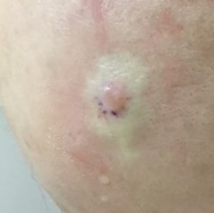 Basal cell carcnioma on forehead