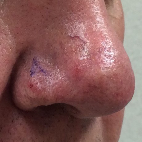 Skin Cancer on nose