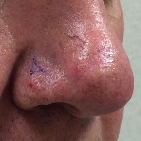 basal cell carcinoma nose scar