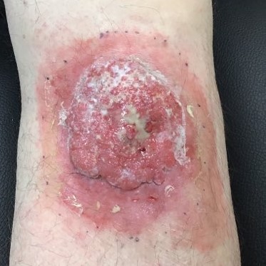 Skin cancer on a lower leg