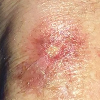 Skin cancer on an arm