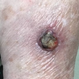 Skin cancer on arm