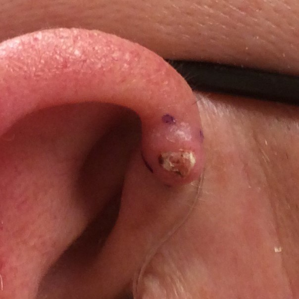 Skin cancer on ear