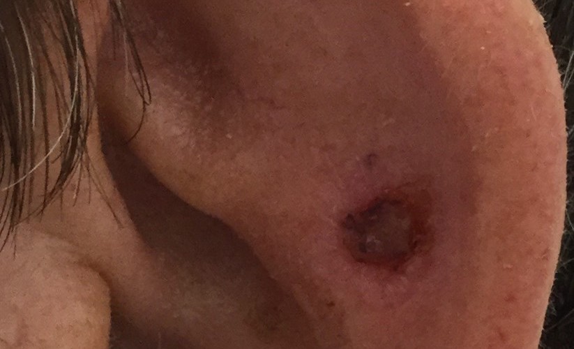 Skin cancer on ear