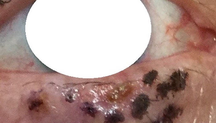 Skin cancer on eyelid