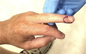 How Skin Cancer Appears on Fingers︱GentleCure