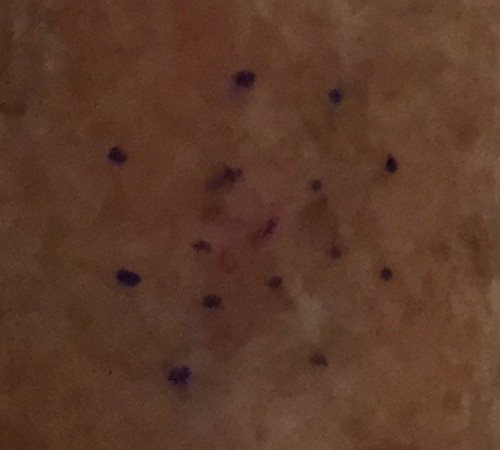 Skin cancer on lower leg
