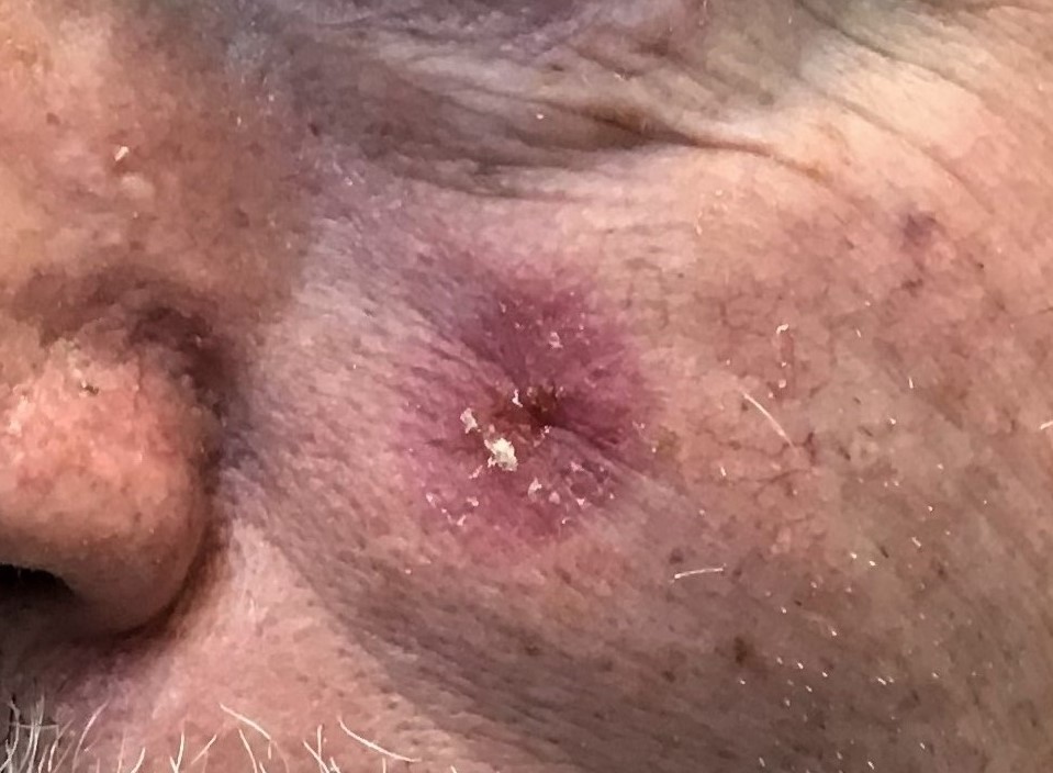 Skin cancer on man's cheek