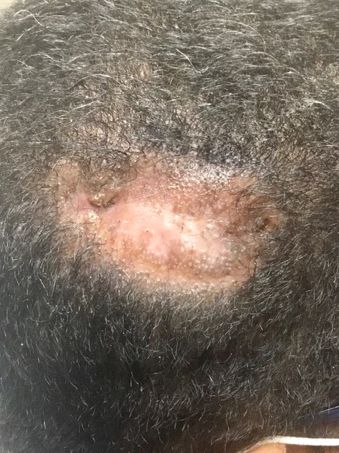 Skin cancer on scalp
