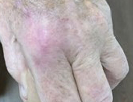Hand showing the results of IG SRT