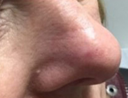 Nose showing the results of IG SRT