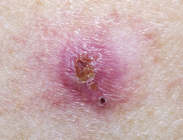 Image of a Basal Cell Skin Cancer