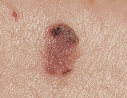 Image of a Squamous Cell Skin Cancer