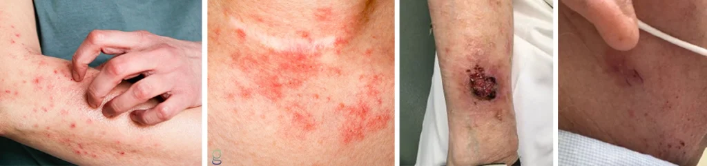 A collage comparing common skin rashes and skin cancer. The two images on the left show itchy, red, scaly rashes, while the two images on the right show non-healing lesions and sores caused by skin cancer.