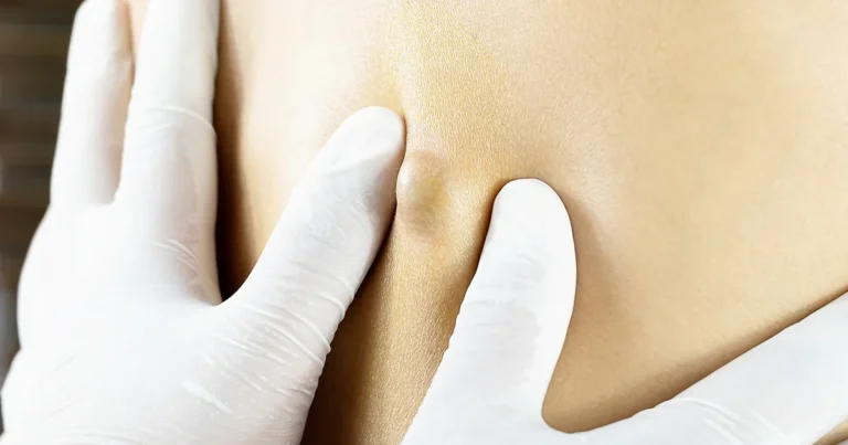 Close-up of a healthcare professional wearing white gloves examining a raised sebaceous cyst on a patient’s back.