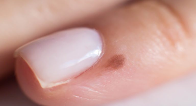Small mole on a finger near a person s nail, close-up