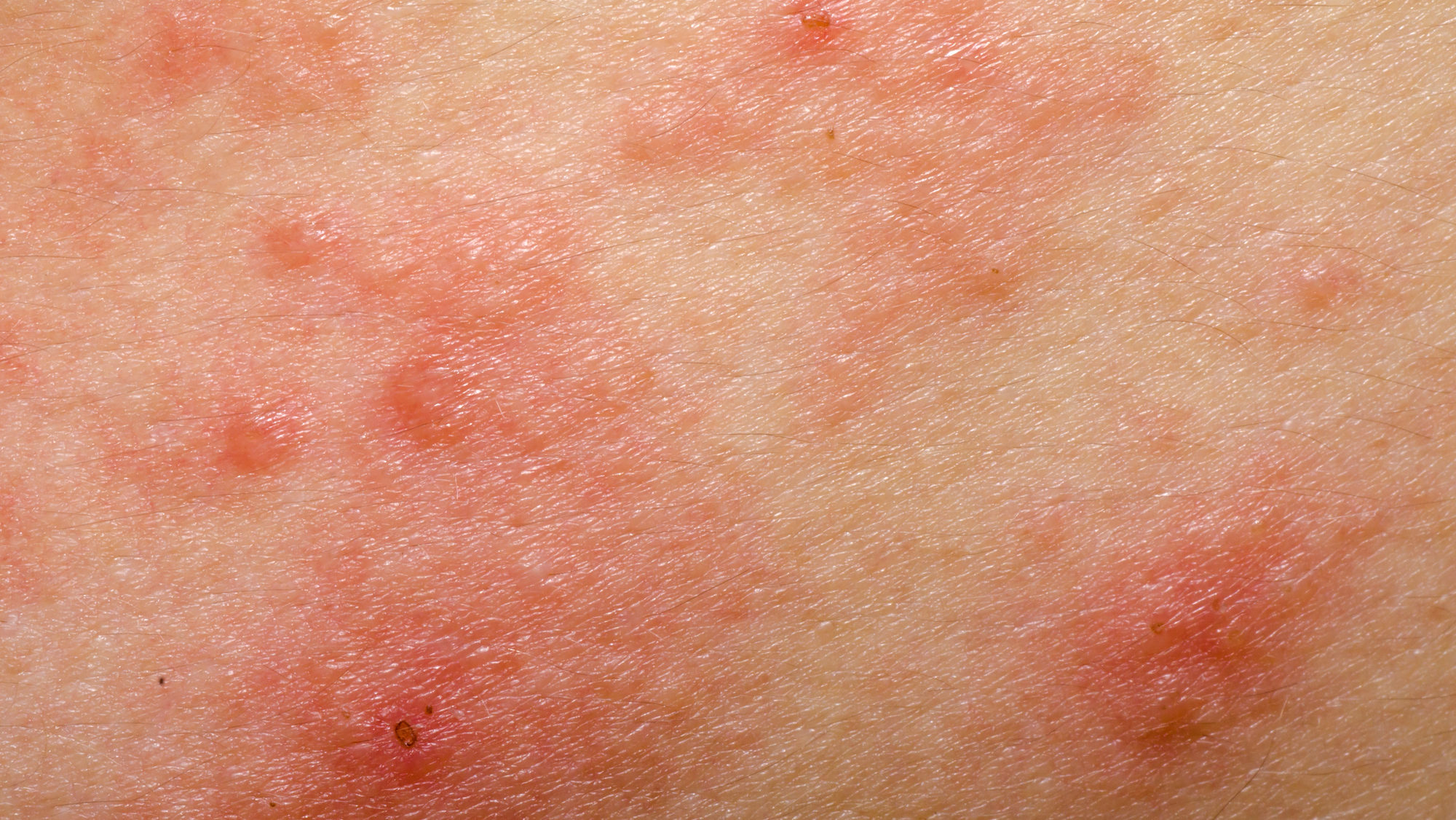 Eczema Vs Skin Cancer GentleCure