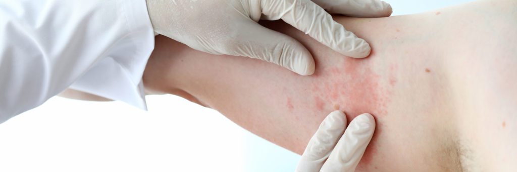 Can Skin Cancer Appear as a Rash?