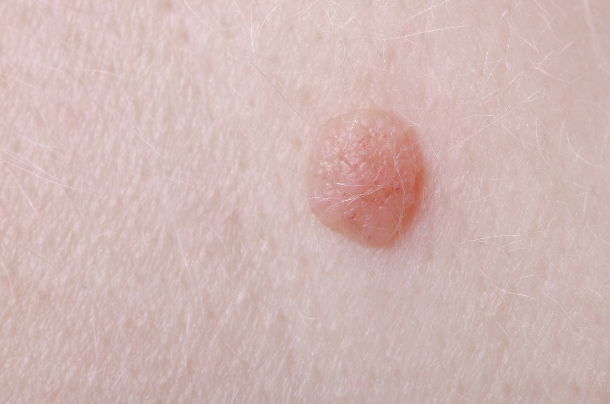 common warts on knee