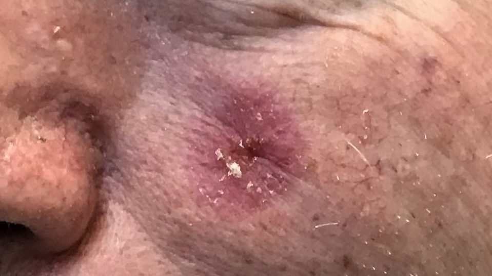Skin cancer on man's cheek