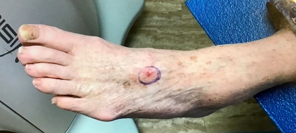 Squamous cell skin cancer on foot